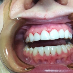  После реставрация верхних зубов