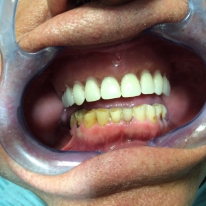 Патологическая стираемость нижних зубов